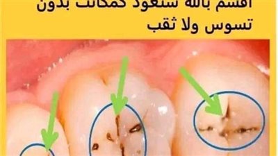 علاج تسوس الاسنان دون الذهاب الي الطبيب